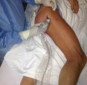 تزریق و بلاک عصب سیاتیک در باسن