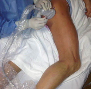 تزریق و بلاک عصب سیاتیک در باسن