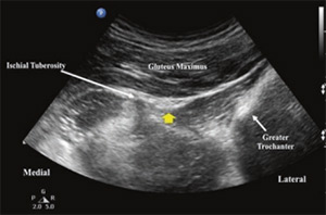 سونوگرافی و بلاک عصب سیاتیک در باسن