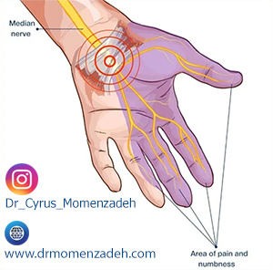 drMomenzadeh, پروفسور دکتر سیروس مومن زاده, درد, درمان درد,درمان درد با لیزر, لیزر درمانی,لیزر تراپی , اوزون تراپی, ازن تراپی, ازون درمانی, درد مچ دست, درد مفصل شست,  درد انگشت دست, درد جسمی, درد روحی, درد معنوی, درد بدن, درد کمر, درد پا, دردصورت, دردچانه, درد اجتماعی، درد گردن, گردن درد,درد شانه ,سر شانه, تونل کارپال, کف دست