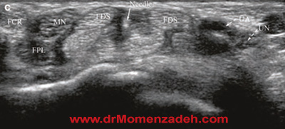 drMomenzadeh, پروفسور دکتر سیروس مومن زاده, درد, درمان درد,درمان درد با لیزر, لیزر درمانی,لیزر تراپی , اوزون تراپی, ازن تراپی, ازون درمانی, درد مچ دست, درد مفصل شست,  درد انگشت دست, درد جسمی, درد روحی, درد معنوی, درد بدن, درد کمر, درد پا, دردصورت, دردچانه, درد اجتماعی، درد گردن, گردن درد,درد شانه ,سر شانه, تونل کارپال, کف دست