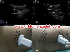 drMomenzadeh,  پرفسور دکتر سیروس مومن زاده, دکتر سیروس مومن زاده,پروفسور دکتر سیروس مومن زاده, درد, درمان درد,درمان درد با لیزر, لیزر درمانی,لیزر تراپی , اوزون تراپی, ازن تراپی, ازون درمانی, درد مچ دست, درد مفصل شست,  درد انگشت دست, درد جسمی, درد روحی, درد معنوی, درد بدن, درد کمر, درد پا, دردصورت, دردچانه, درد اجتماعی، درد گردن, گردن درد,درد شانه ,سر شانه, تونل کارپال, کف دست, مفصل آرنج, درد بازو, درد آرنج, درد ترقوه, عصب سوپرا اربیتال,شبکه عصبی  کمر 