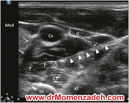 www.drMomenzadeh.com, پرفسور دکتر سیروس مومن زاده, دکتر سیروس مومن زاده,پروفسور دکتر سیروس مومن زاده, درد, درمان درد,درمان درد با لیزر, لیزر درمانی,لیزر تراپی , اوزون تراپی, ازن تراپی, ازون درمانی, درد مچ دست, درد مفصل شست,  درد انگشت دست, درد جسمی, درد روحی, درد معنوی, درد بدن, درد کمر, درد پا, دردصورت, دردچانه, درد اجتماعی، درد گردن, گردن درد,درد شانه ,سر شانه, تونل کارپال, کف دست, مفصل آرنج, درد بازو, درد آرنج, درد ترقوه, سمپاتیک گردنی