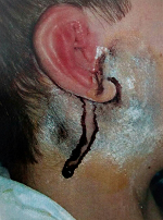 درمان درد گوش و گونه با یلاک عصب اوریکولوتمپورال (گوشی-گیجگاهی)