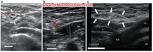 www.drMomenzadeh.com, پرفسور دکتر سیروس مومن زاده, دکتر سیروس مومن زاده,پروفسور دکتر سیروس مومن زاده, درد, درمان درد,درمان درد با لیزر, لیزر درمانی,لیزر تراپی , اوزون تراپی, ازن تراپی, ازون درمانی, درد مچ دست, درد مفصل شست,  درد انگشت دست, درد جسمی, درد روحی, درد معنوی, درد بدن, درد کمر, درد پا, دردصورت, دردچانه, درد اجتماعی، درد گردن, گردن درد,درد شانه ,سر شانه, تونل کارپال, کف دست, مفصل آرنج, درد بازو, درد آرنج, درد ترقوه, عصب سوپرا اربیتال, عصب جمینوفمورال