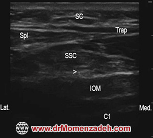 drMomenzadeh, پرفسور دکتر سیروس مومن زاده, دکتر سیروس مومن زاده,پروفسور دکتر سیروس مومن زاده, درد, درمان درد,درمان درد با لیزر, لیزر درمانی,لیزر تراپی , اوزون تراپی, ازن تراپی, ازون درمانی, درد مچ دست, درد مفصل شست,  درد انگشت دست, درد جسمی, درد روحی, درد معنوی, درد بدن, درد کمر, درد پا, دردصورت, دردچانه, درد اجتماعی، درد گردن, گردن درد,درد شانه ,سر شانه, تونل کارپال, کف دست, مفصل آرنج, درد بازو, درد آرنج, درد ترقوه, عصب سوپرا اربیتال, بلاک عصب اینفرا اربیتال, تحریک عصب اکسیپیتال