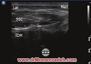 drMomenzadeh,پرفسور دکتر سیروس مومن زاده, دکتر سیروس مومن زاده,پروفسور دکتر سیروس مومن زاده, درد, درمان درد,درمان درد با لیزر, لیزر درمانی,لیزر تراپی , اوزون تراپی, ازن تراپی, ازون درمانی, درد مچ دست, درد مفصل شست,  درد انگشت دست, درد جسمی, درد روحی, درد معنوی, درد بدن, درد کمر, درد پا, دردصورت, دردچانه, درد اجتماعی، درد گردن, گردن درد,درد شانه ,سر شانه, تونل کارپال, کف دست, مفصل آرنج, درد بازو, درد آرنج, درد ترقوه, عصب سوپرا اربیتال, بلاک عصب اینفرا اربیتال, تحریک عصب اکسیپیتال