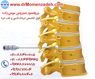 بلاک اپیدورال سینه‌ای