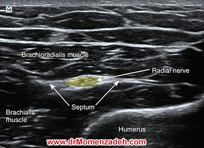 drMomenzadeh, درد,درمان درد با لیزر, لیزر درمانی,لیزر تراپی , اوزون تراپی, ازن تراپی, ازون درمانی, درد مچ دست, درد مفصل شست, درد انگشت دست, درد جسمی, درد روحی, درد معنوی, درد بدن, درد کمر, درد پا, دردصورت, دردچانه, درد اجتماعی، درد گردن, گردن درد, درد شانه, بلاک عصب رادیال, درد بازو