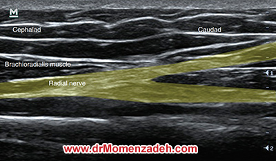 drMomenzadeh, درد,درمان درد با لیزر, لیزر درمانی,لیزر تراپی , اوزون تراپی, ازن تراپی, ازون درمانی, درد مچ دست, درد مفصل شست, درد انگشت دست, درد جسمی, درد روحی, درد معنوی, درد بدن, درد کمر, درد پا, دردصورت, دردچانه, درد اجتماعی، درد گردن, گردن درد, درد شانه, بلاک عصب رادیال, درد بازو