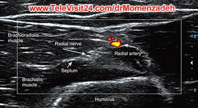 شریان رادیال, درد,درمان درد با لیزر, لیزر درمانی,لیزر تراپی , اوزون تراپی, ازن تراپی, ازون درمانی, درد مچ دست, درد مفصل شست, درد انگشت دست, درد جسمی, درد روحی, درد معنوی, درد بدن, درد کمر, درد پا, دردصورت, دردچانه, درد اجتماعی، درد گردن, گردن درد, درد شانه, بلاک عصب رادیال, درد بازو