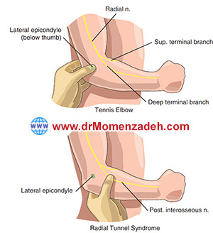 سندرم تونل رادیال, درد,درمان درد با لیزر, لیزر درمانی,لیزر تراپی , اوزون تراپی, ازن تراپی, ازون درمانی, درد مچ دست, درد مفصل شست, درد انگشت دست, درد جسمی, درد روحی, درد معنوی, درد بدن, درد کمر, درد پا, دردصورت, دردچانه, درد اجتماعی، درد گردن, گردن درد, درد شانه, بلاک عصب رادیال, درد بازو