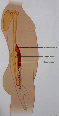 درمان درد ساعد و بازو ناشی از سندروم براکیورادیالیس