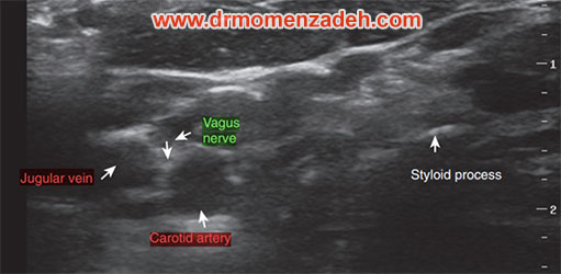 drMomenzadeh,پروفسور دکتر سیروس مومن زاده,  دکتر سیروس مومن زاده ,سیروس مومن زاده, پروفسور سیروس مومن زاده, درد شناسی, فوق تخصص, درمان درد, درد, لیزر درمانی, لیزرتراپی, ازن تراپی, اوزون درمانی, درد کمر, کمردرد, درد پا, درد گردن, گردن درد, درد دست, زانو درد, درد زانو,   مفاصل فست گردنی, ستون فقرات, آرتریت, پشت سر, ضعف سیستم ایمنی, گاید سونوگرافی,  درد حنجره, درد حنجره, درد دهان, عصب گلوسوفارنژیال, بلاک عصب واگ