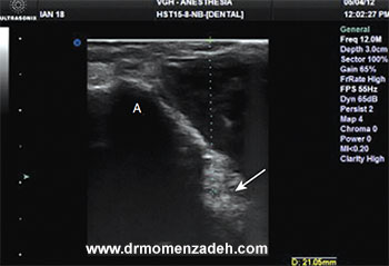 drMomenzadeh,پروفسور دکتر سیروس مومن زاده, دکتر سیروس مومن زاده ,سیروس مومن زاده, پروفسور سیروس مومن زاده, درد شناسی, فوق تخصص, درمان درد, درد, لیزر درمانی, لیزرتراپی, ازن تراپی, اوزون درمانی, درد کمر, کمردرد, درد پا, درد گردن, گردن درد, درد دست, زانو درد, درد زانو, مفاصل فست گردنی, ستون فقرات, آرتریت, پشت سر, ضعف سیستم ایمنی, گاید سونوگرافی, درد حنجره, درد حنجره, درد دهان, درد بازو, بلاک شبکه بازویی, عصب اینفریور آلوئولار, عصب مندیبولار, ,Mandibular Inferior Alveolar