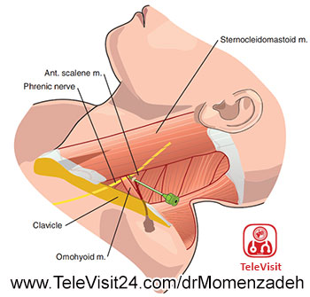 drMomenzadeh,پروفسور دکتر سیروس مومن زاده, دکتر سیروس مومن زاده ,سیروس مومن زاده, پروفسور سیروس مومن زاده, درد شناسی, فوق تخصص, درمان درد, درد, لیزر درمانی, لیزرتراپی, ازن تراپی, اوزون درمانی, درد کمر, کمردرد, درد پا, درد گردن, گردن درد, درد دست, زانو درد, درد زانو, مفاصل فست گردنی, ستون فقرات, آرتریت, پشت سر, ضعف سیستم ایمنی, گاید سونوگرافی, درد حنجره, درد حنجره, درد دهان, درد بازو, بلاک شبکه بازویی, فست گردن, درد کنار گردن تا قفسه سینه, اعصاب نخاعی گردنی, بلاک عصب فرنیک, Phrenic