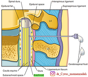 بلاک ساب آراکنوئید کمری